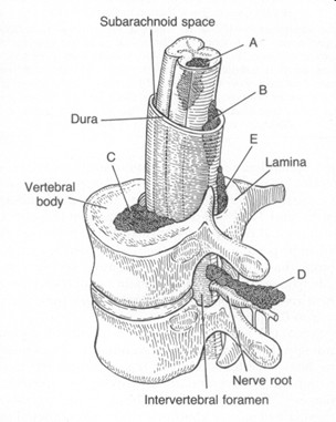 Figure 1 Spinal epidural metastases