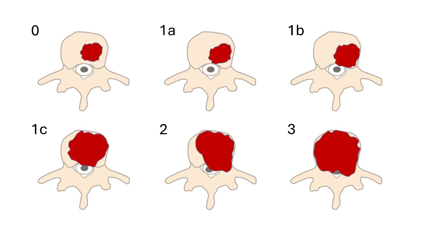 Figure 2 Bilsky grades