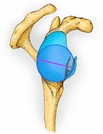Figuur 1 De best fit circle scapula glenoidaal botverlies