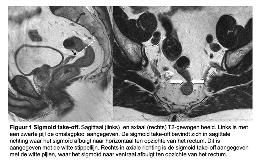 Figuur 1 Sigmoid take-off