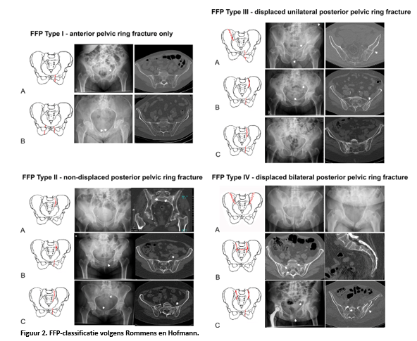 Figuur 2 Rommens-classificatie voor Fragility Fractures of the Pelvis