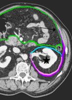 Figuur 2a Anatomie retroperitoneale ruimte
