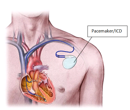Pacemaker/ICD