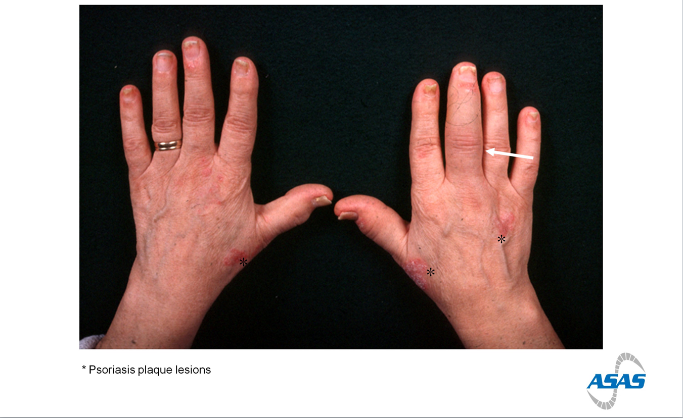 artritis psoriatica handen)