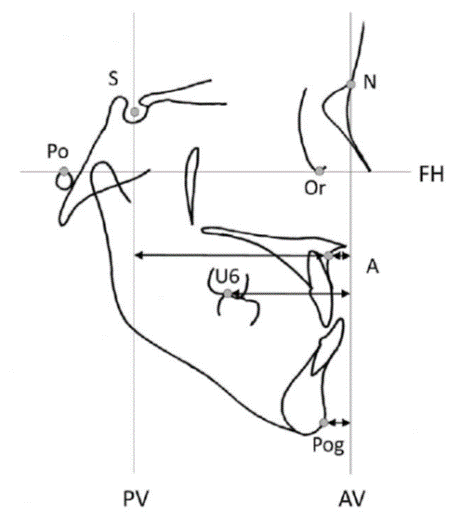 Figure 4. Reference lines and measurements of the antero-posterior positions of point A (A), pogonion (Pog) and maxillary first molar (U6).